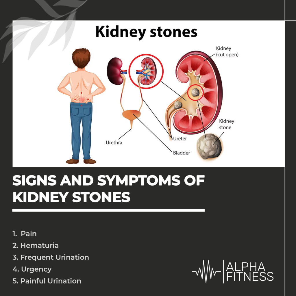 Signs and symptoms of kidney stones - AlphaFitness.Health