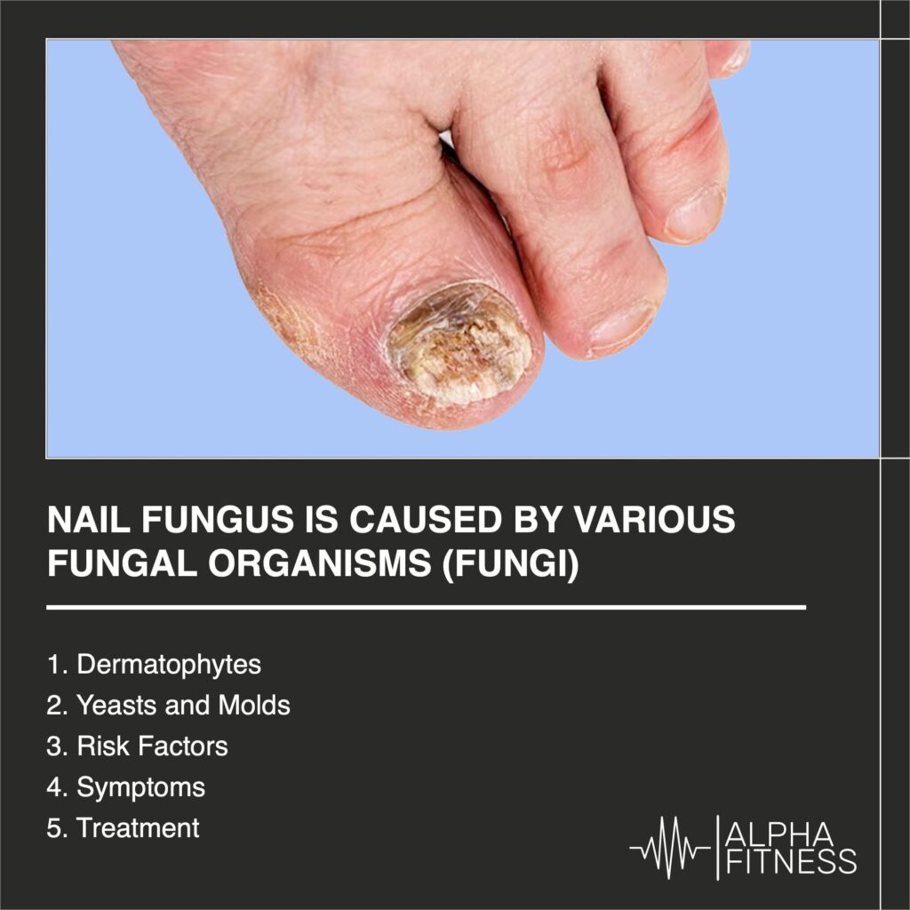 Nail fungus is caused by various fungal organisms (fungi) - AlphaFitness.Health