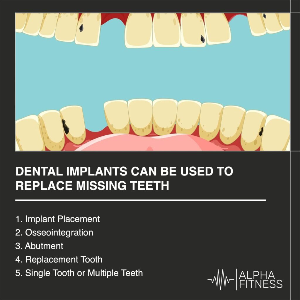 Dental implants can be used to replace missing teeth - alphafitness.health