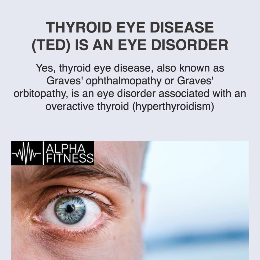 Thyroid eye disease (TED) is an eye disorder - alphafitness.health