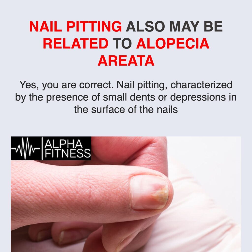 Nail pitting also may be related to alopecia areata - alphafitness.health